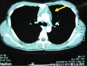前縦隔腫瘍：胸部CT所見