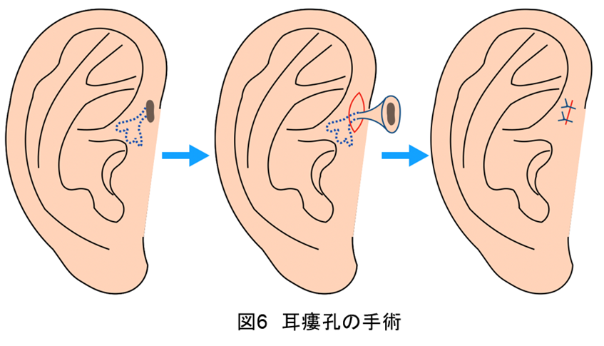 先天性耳瘻孔3