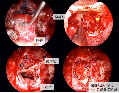 craniopharyngioma2