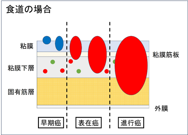 ESD食道の場合