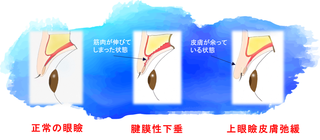 加齢による眼瞼下垂症 加齢による眼瞼下垂症