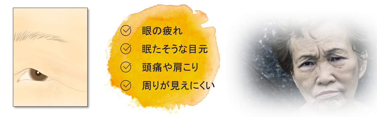 上眼瞼皮膚弛緩(じょうがんけんひふしかん)=皮膚のたるみ 上眼瞼皮膚弛緩(じょうがんけんひふしかん)=皮膚のたるみ