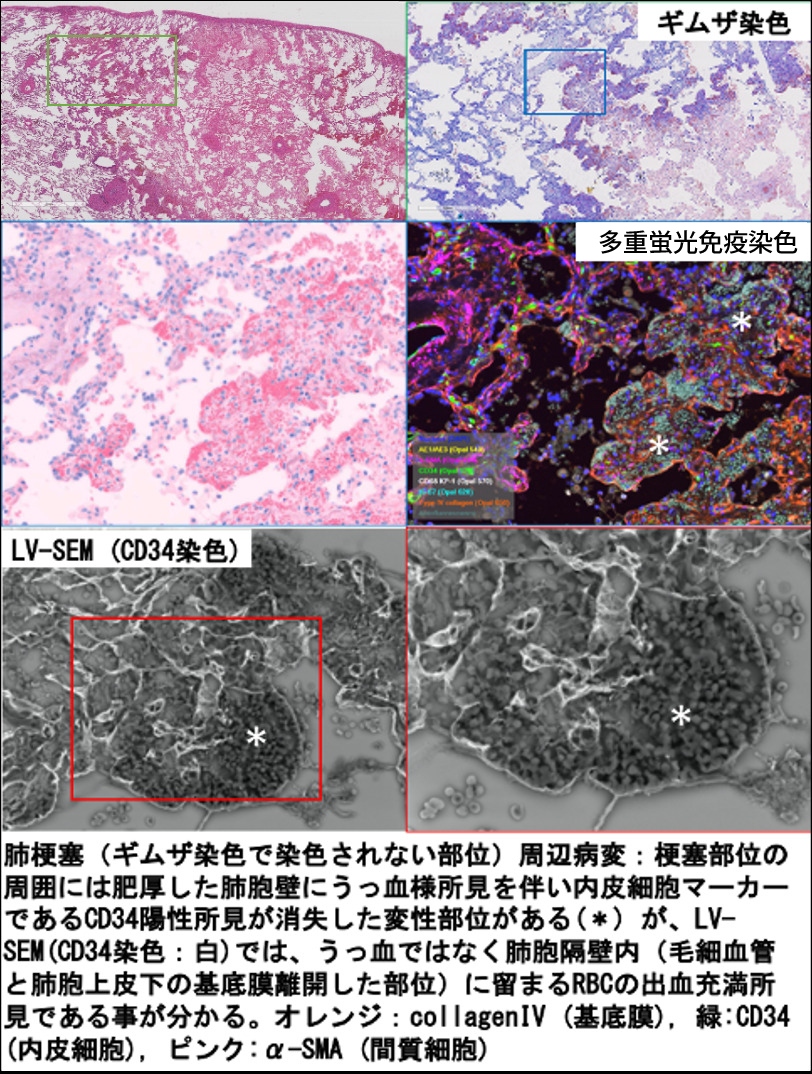 活動性を有するIgA腎症