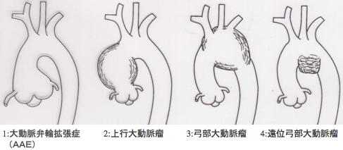 図1 真性胸部大動脈瘤の種類
