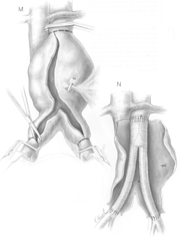 図2 腹部大動脈瘤の手術