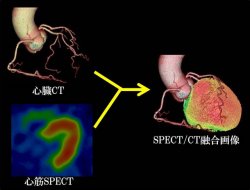 図3 心臓SPECT/CT融合画像の作成
