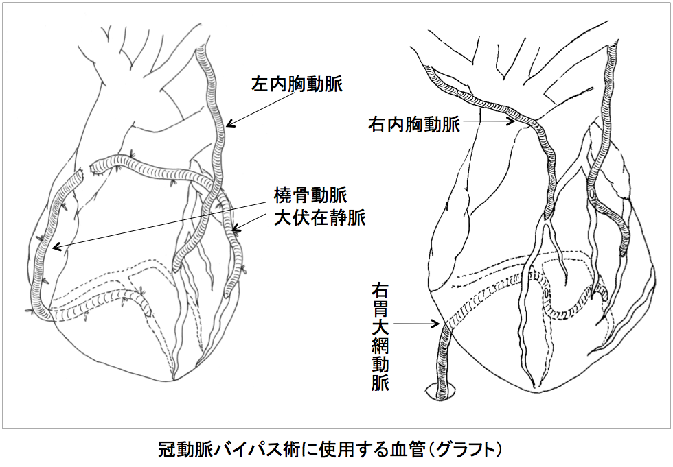 冠動脈バイパス術に使用する血管（グラフト）