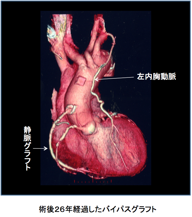 冠動脈バイパス手術 日本医科大学付属病院