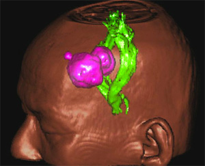 トラクトグラフィー Tractography1