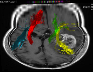 トラクトグラフィー Tractography2