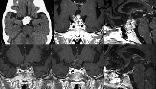 craniopharyngioma1