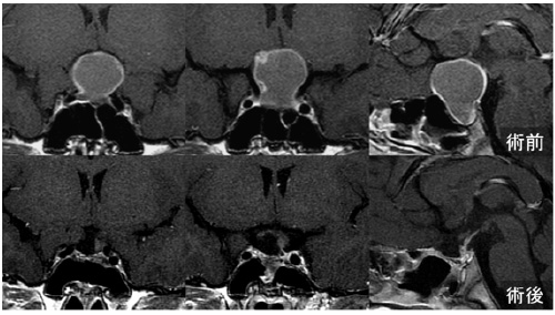 craniopharyngioma3