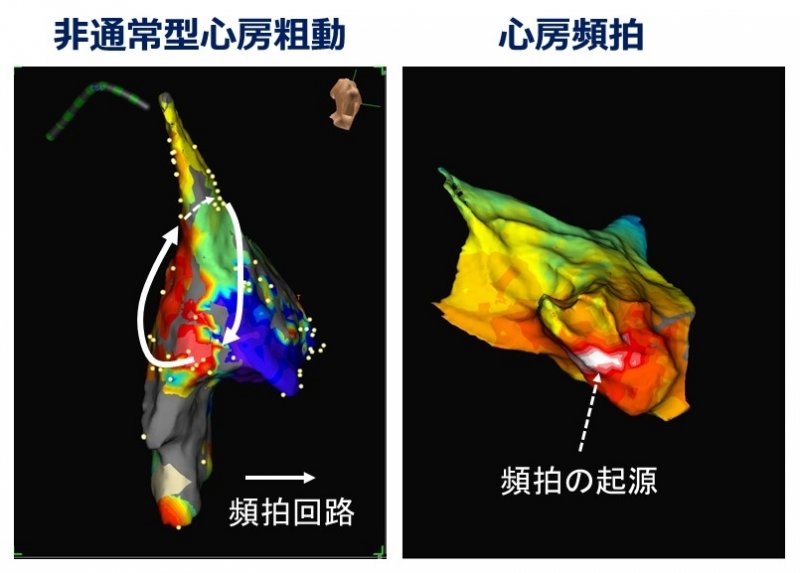 心房粗動・心房頻拍のカテーテルアブレーション