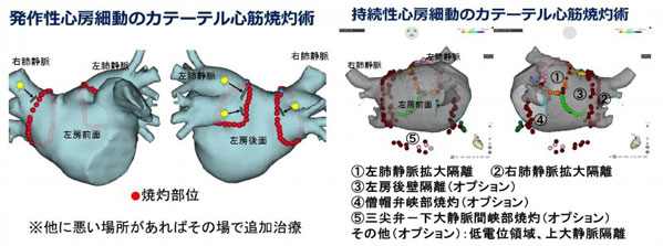 発作性心房細動のカテーテル心筋焼灼術・持続性心房細動のカテーテル心筋焼灼術