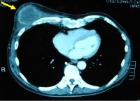 胸部　CT：巨大胸壁転移