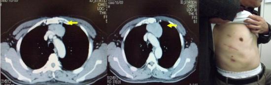 前縦隔腫瘍（最大径 8cm）：胸部CT所見と術後創部写真