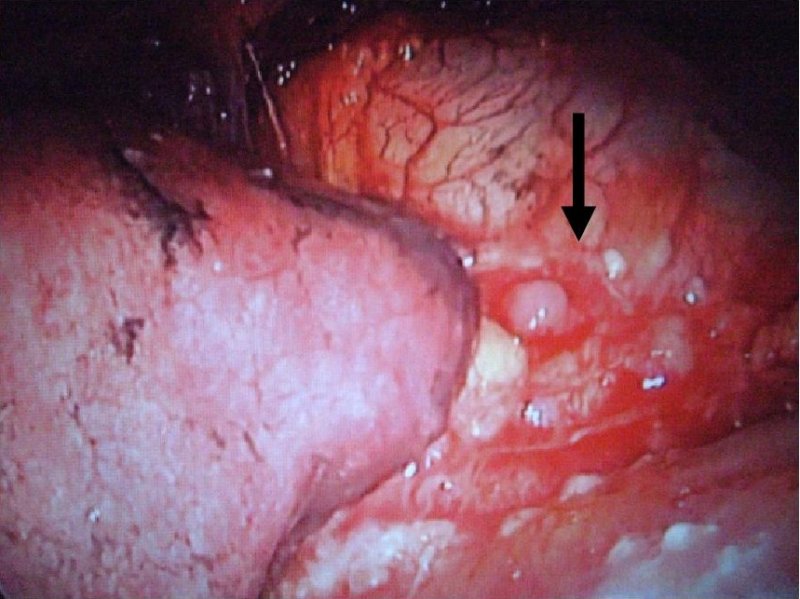 心膜、横隔膜の腫瘍