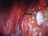 壁側胸膜の腫瘍多発 （白色調結節）
