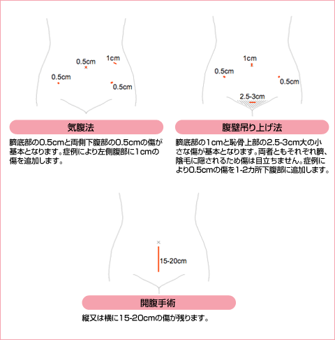 腹腔鏡手術と開腹手術の比較 腹腔鏡手術と開腹手術の比較