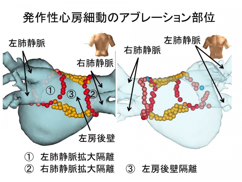 発作性心房細動のカテーテルアブレーション部位