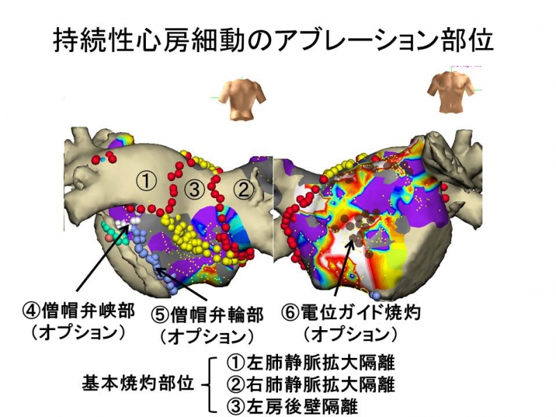 持続性心房細動のカテーテルアブレーション部位