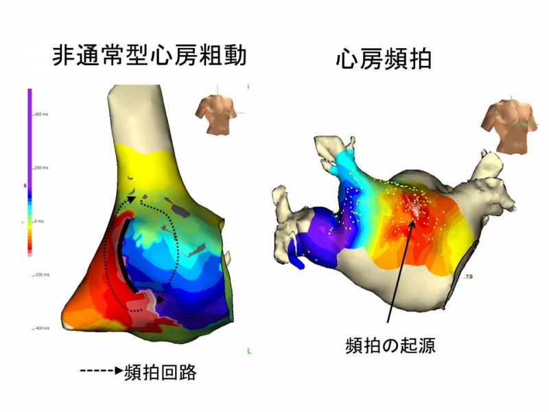 心房粗動・心房頻拍のカテーテルアブレーション