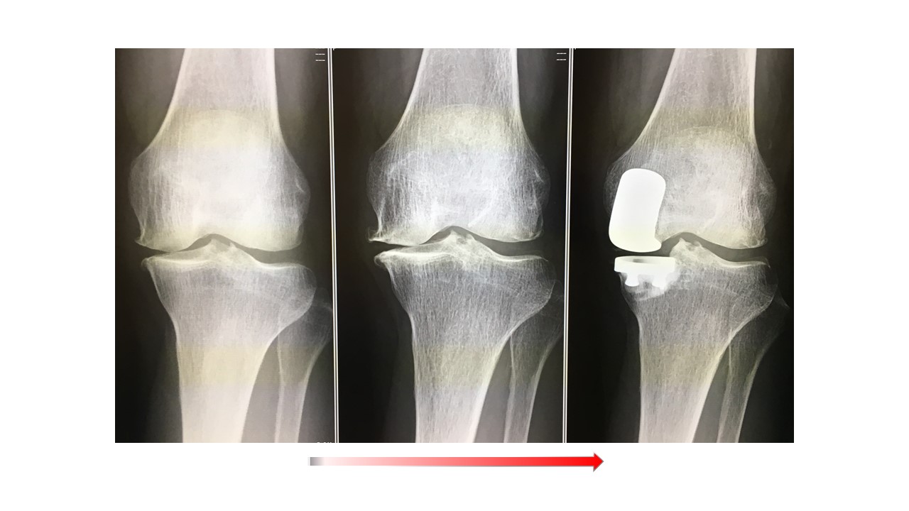 人工膝関節単顆置換術後
