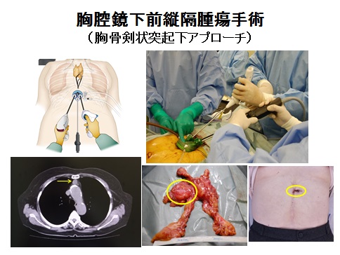 胸腔鏡下前縦隔腫瘍手術（胸骨剣状突起下アプローチ）