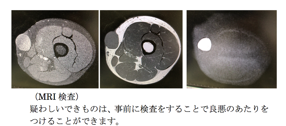 悪性か否かの検査