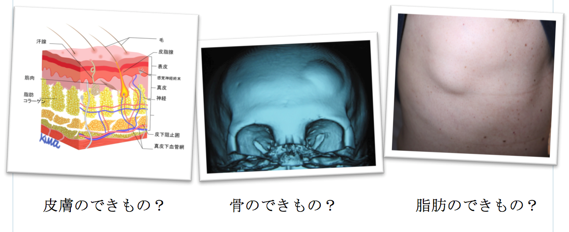 脂肪腫、血管腫、平滑筋種、神経鞘腫、骨腫、脂肪肉腫、滑膜肉腫、横紋筋肉腫、軟骨肉腫、粘液線維肉腫の鑑別