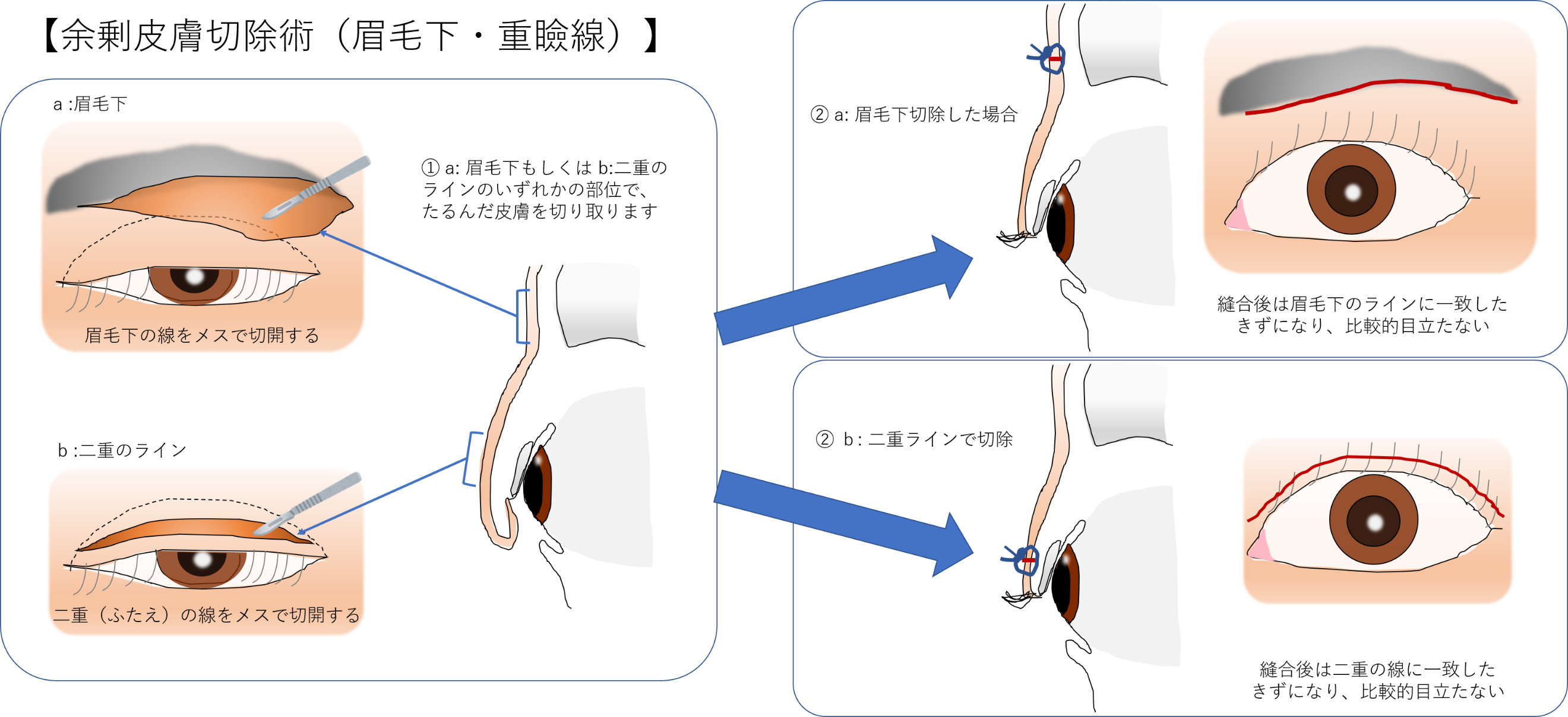 余剰皮膚切除術