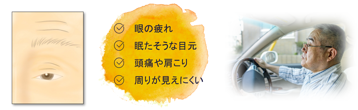 腱膜性眼瞼下垂（けんまくせいがんけんかすい）＝筋肉のゆるみ