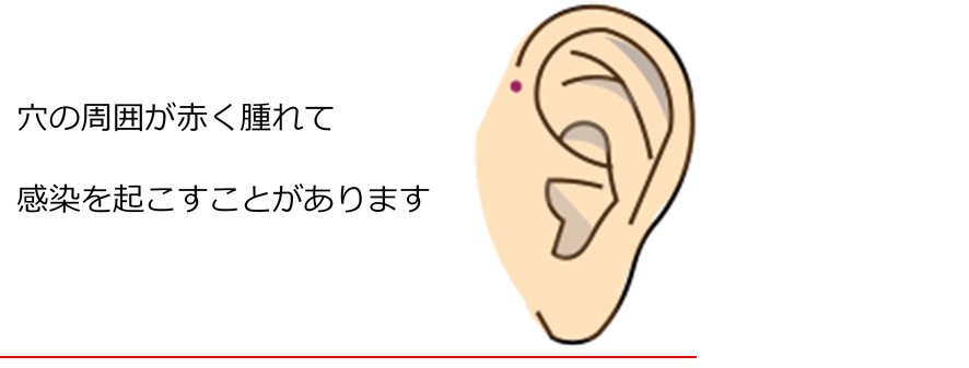 耳瘻孔
