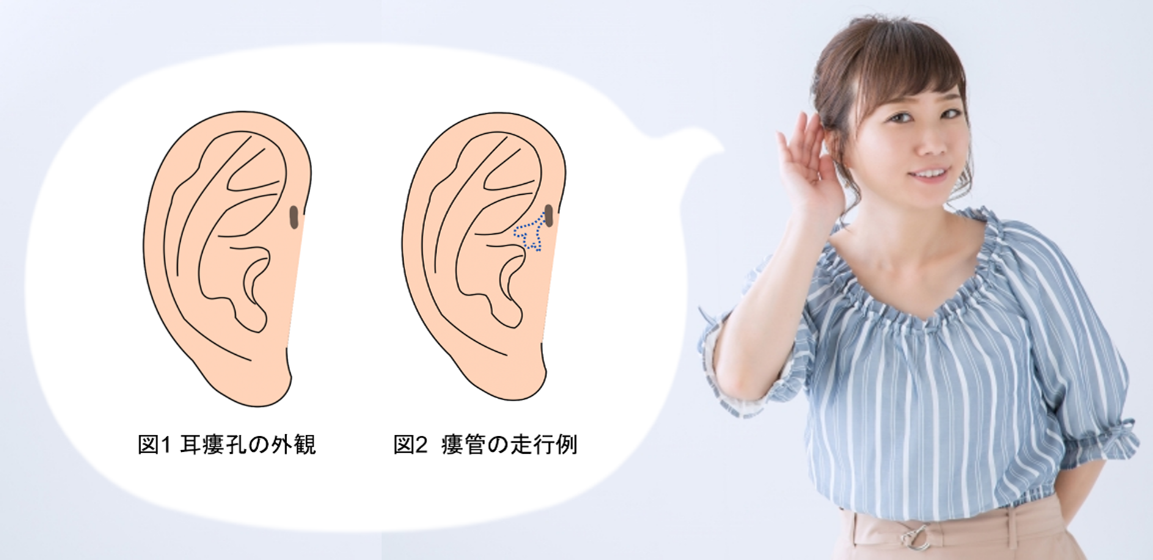 先天性耳瘻孔1