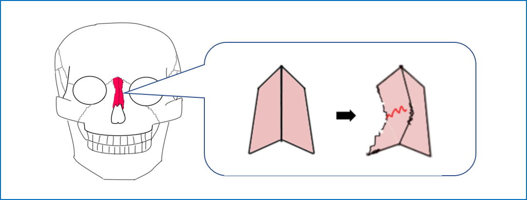 鼻骨骨折の問題は？