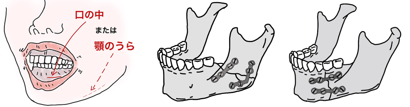 下顎骨5