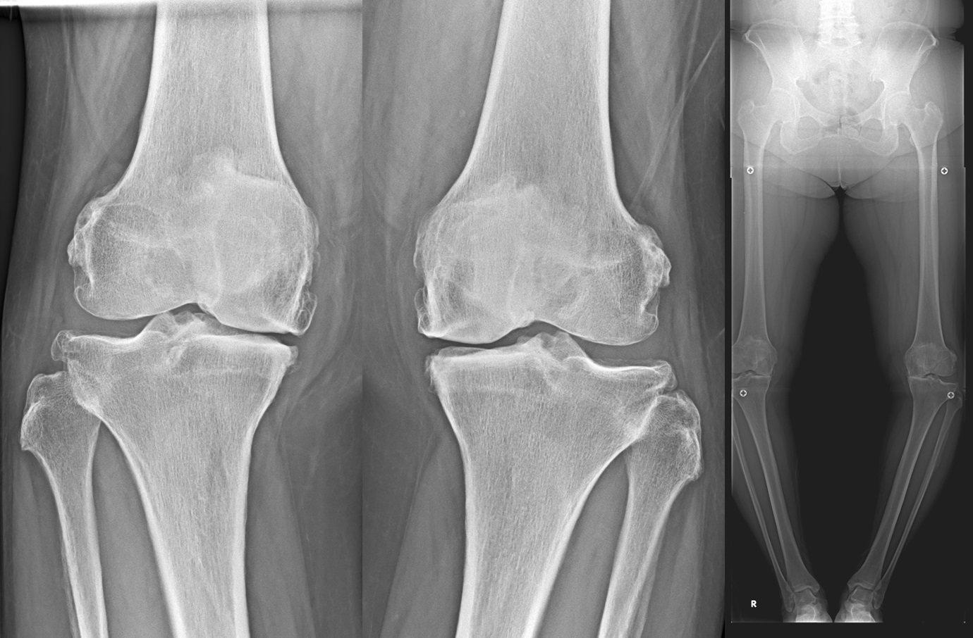 人工膝関節全置換術1