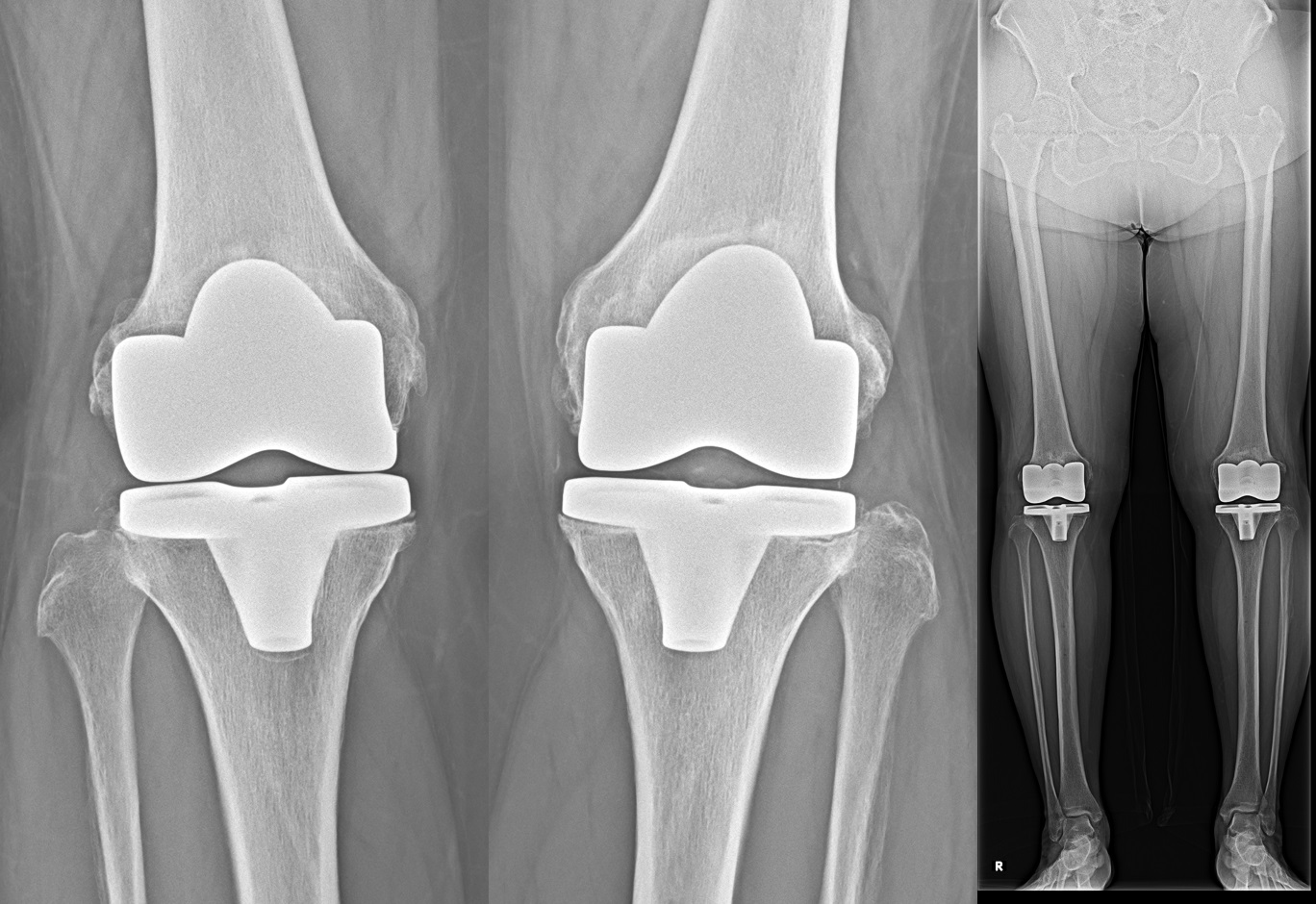 人工膝関節全置換術２