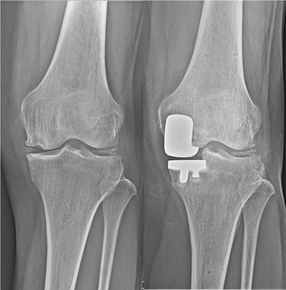 人工膝関節単顆置換術