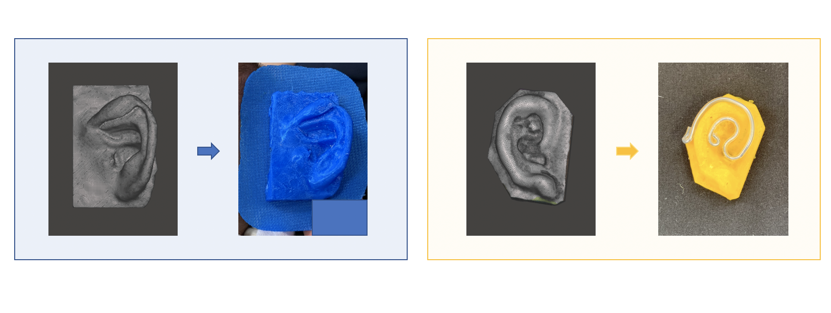 先天性耳介変形3（埋没耳や折れ耳）に対する早期治療