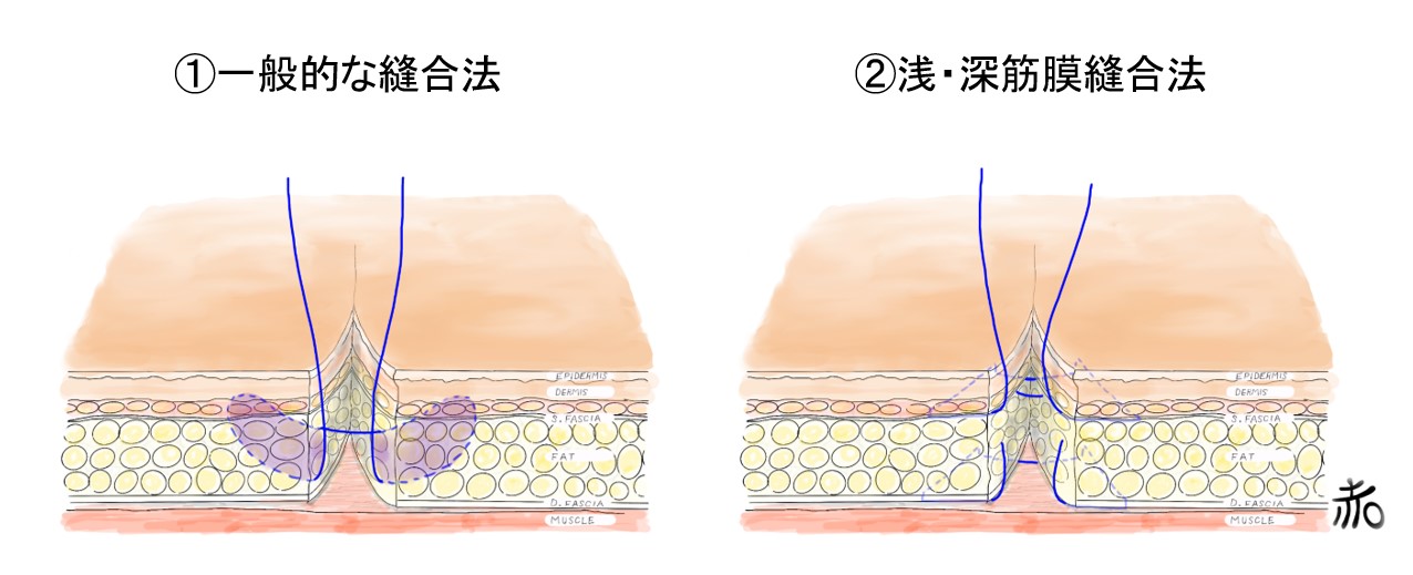 ケロイド手術のための縫合法