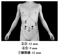 腹腔鏡下膵体尾部切除術の写真