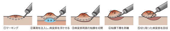 ESDの手順1