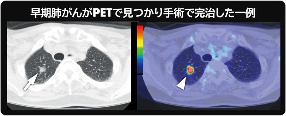 2-02_早期肺がん手術完治一例