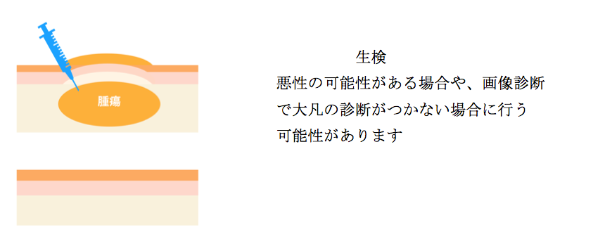 軟部腫瘍手術方法 軟部腫瘍手術方法