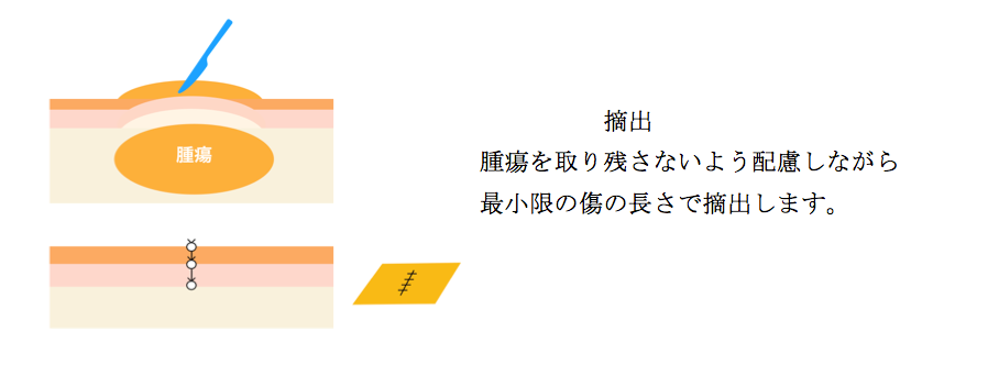 軟部腫瘍手術方法 軟部腫瘍手術方法