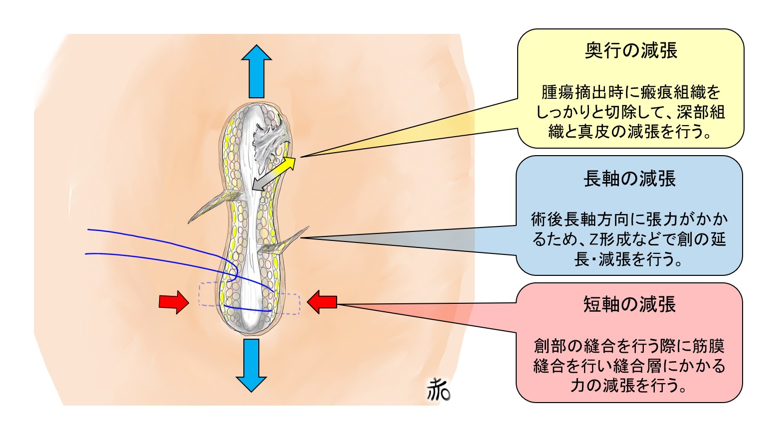 ケロイド手術の目的 ケロイド手術の目的
