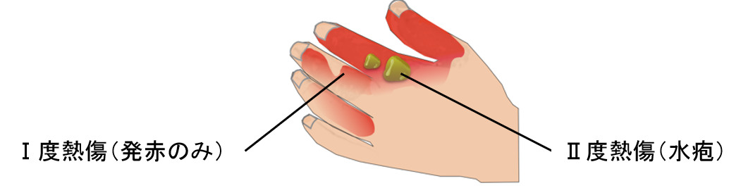 熱傷(火傷、やけど)の深さ 熱傷(火傷、やけど)の深さ