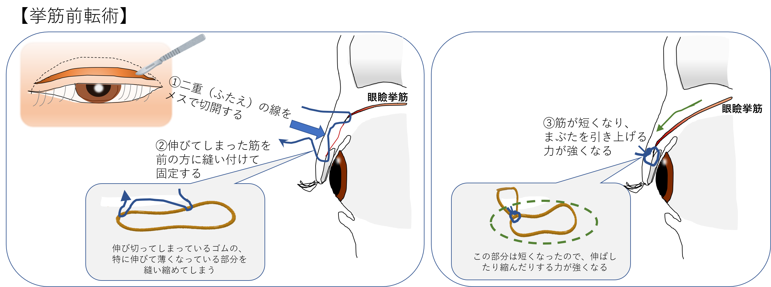 挙筋前転術 挙筋前転術