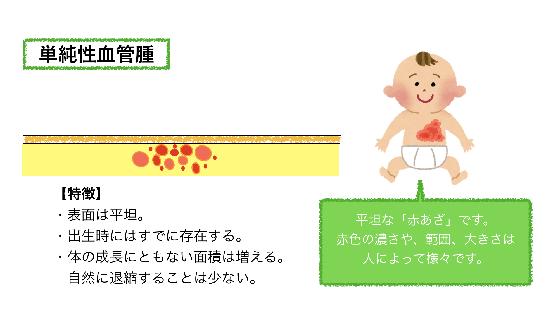 単純性血管腫 単純性血管腫